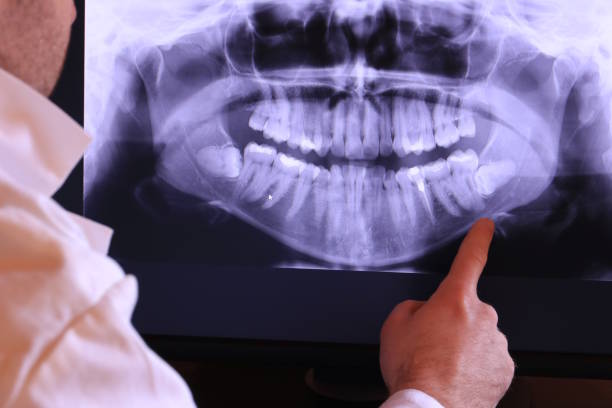 Best Emergency Dental Extractions in Granbury, TX