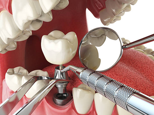 Best Emergency Dentist for Lost Fillings or Crowns in Granbury, TX